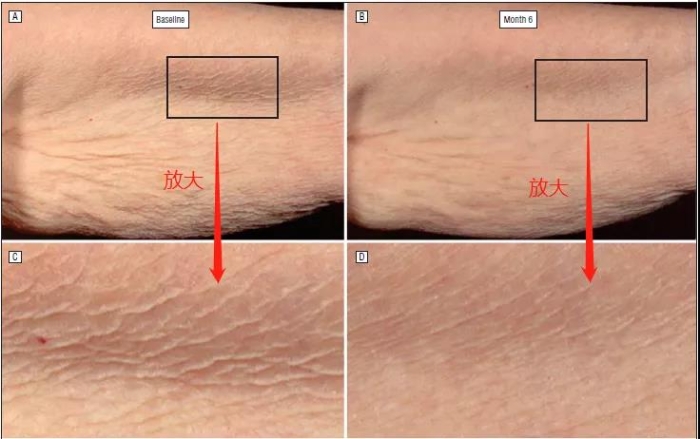 图1 视黄醇改善皮肤细纹